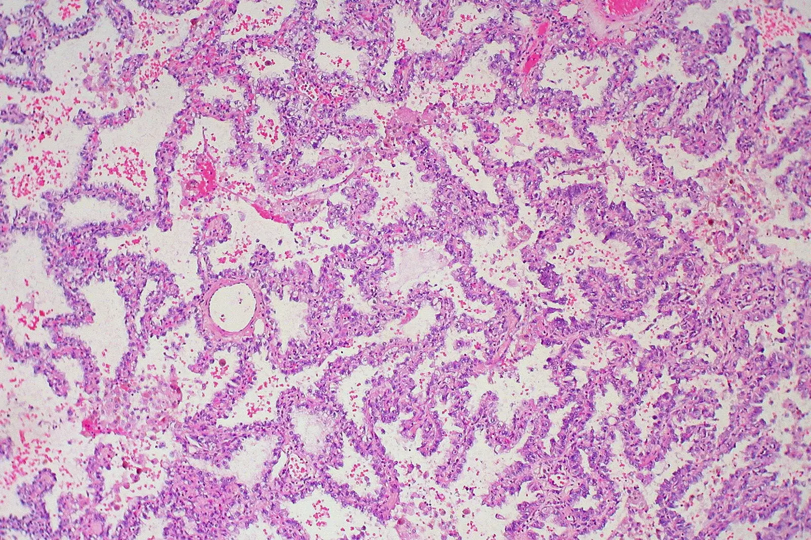 Microscope view of lung adenocarcinoma stained pink and purple, with tumour cells lining the walls of the lung's air sacs